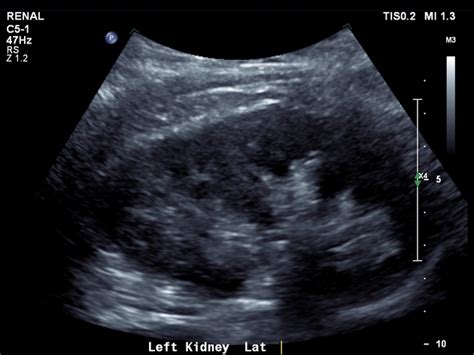 kub ultrasound normal results|Normal renal tract ultrasound (female) .